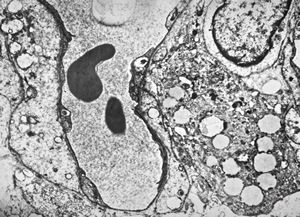 M,28y. | hemangioblastoma - brain